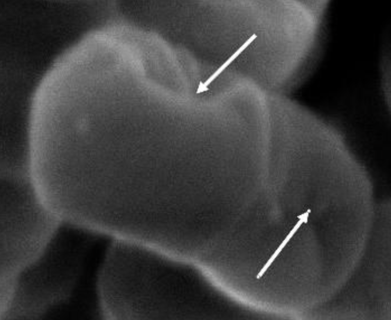 A new precision tool helps combat bacteria in the teeth and gums.